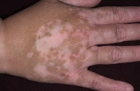 vitiligo-16.jpg